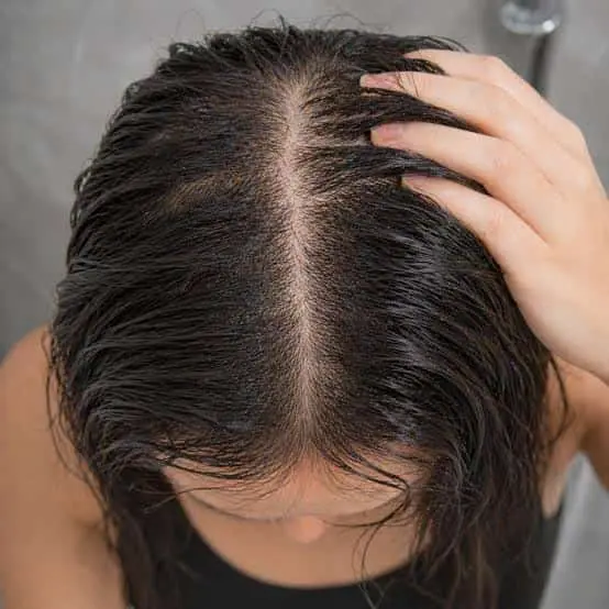 Alopecia Androgenética en Panamá