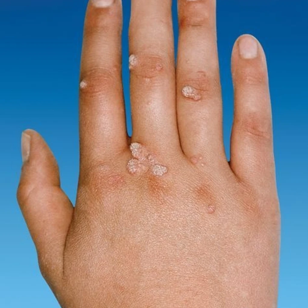 Signos y síntomas de las Verrugas Vulgares en el dorso de la mano