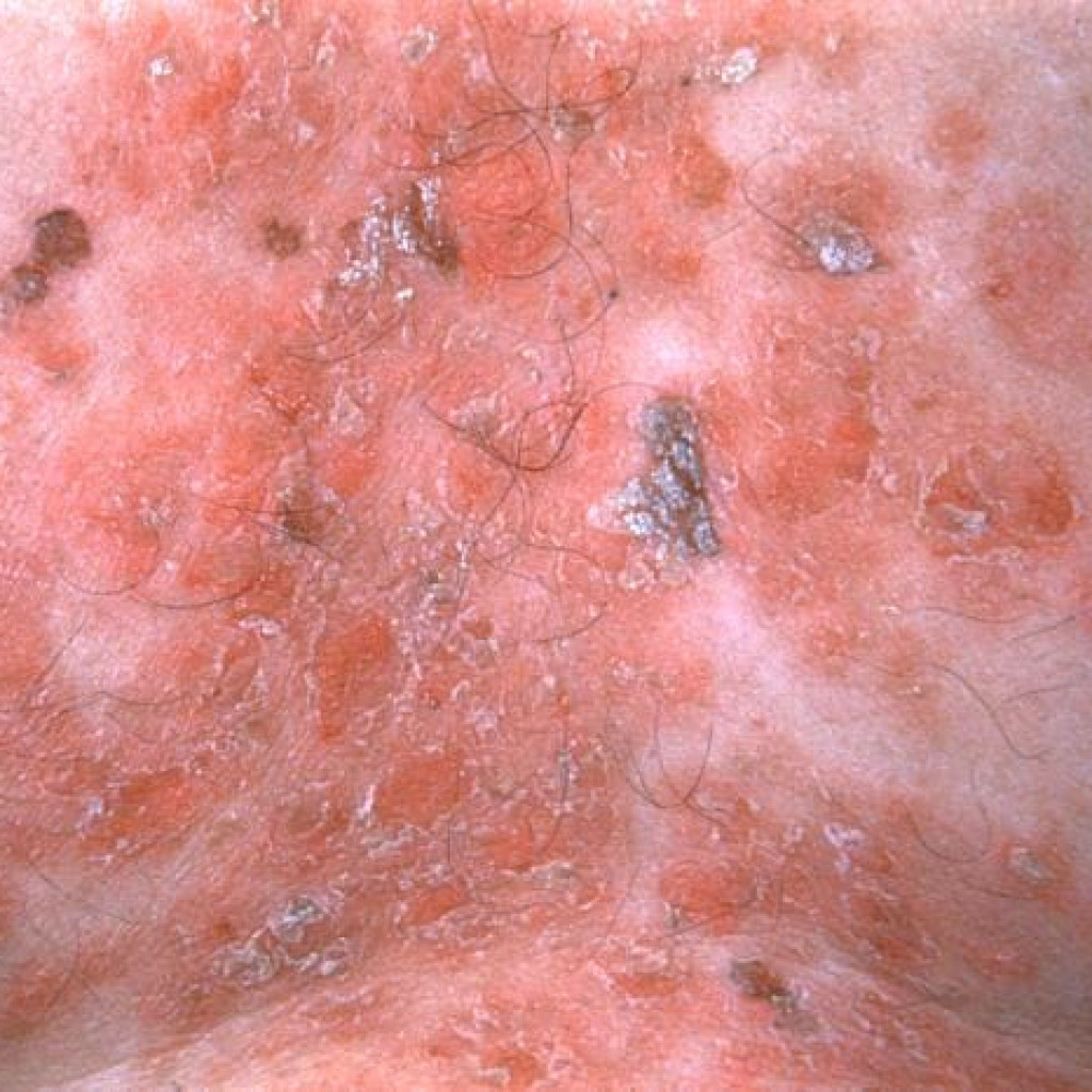 Herpes zoster con lesiones en banda sobre el torax