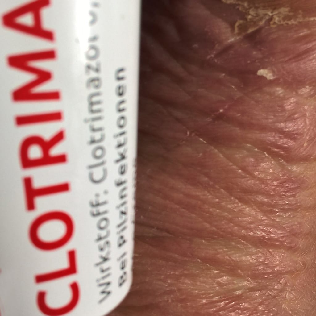 Tratamiento tópico antimicótico con crema de clotrimazol