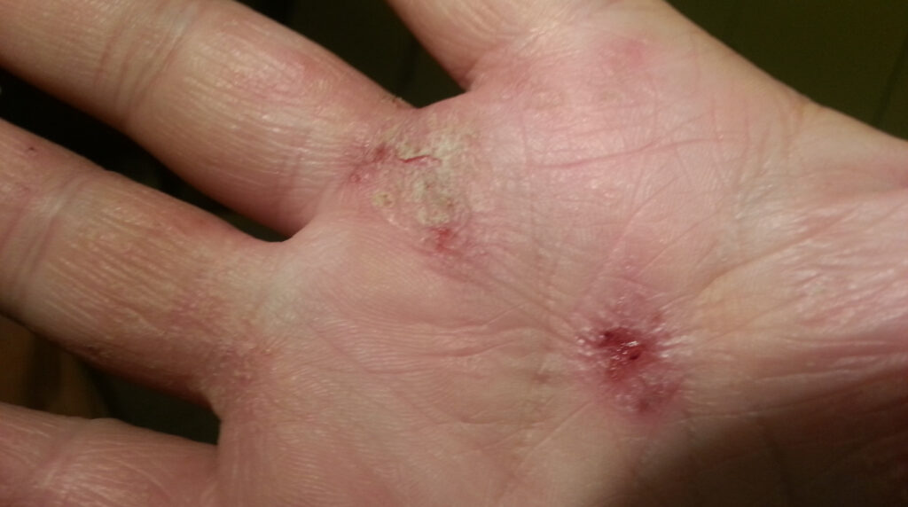 Dermatitis atópica en Panamá: evaluación de la piel con la Dra. Sulem Cedeño