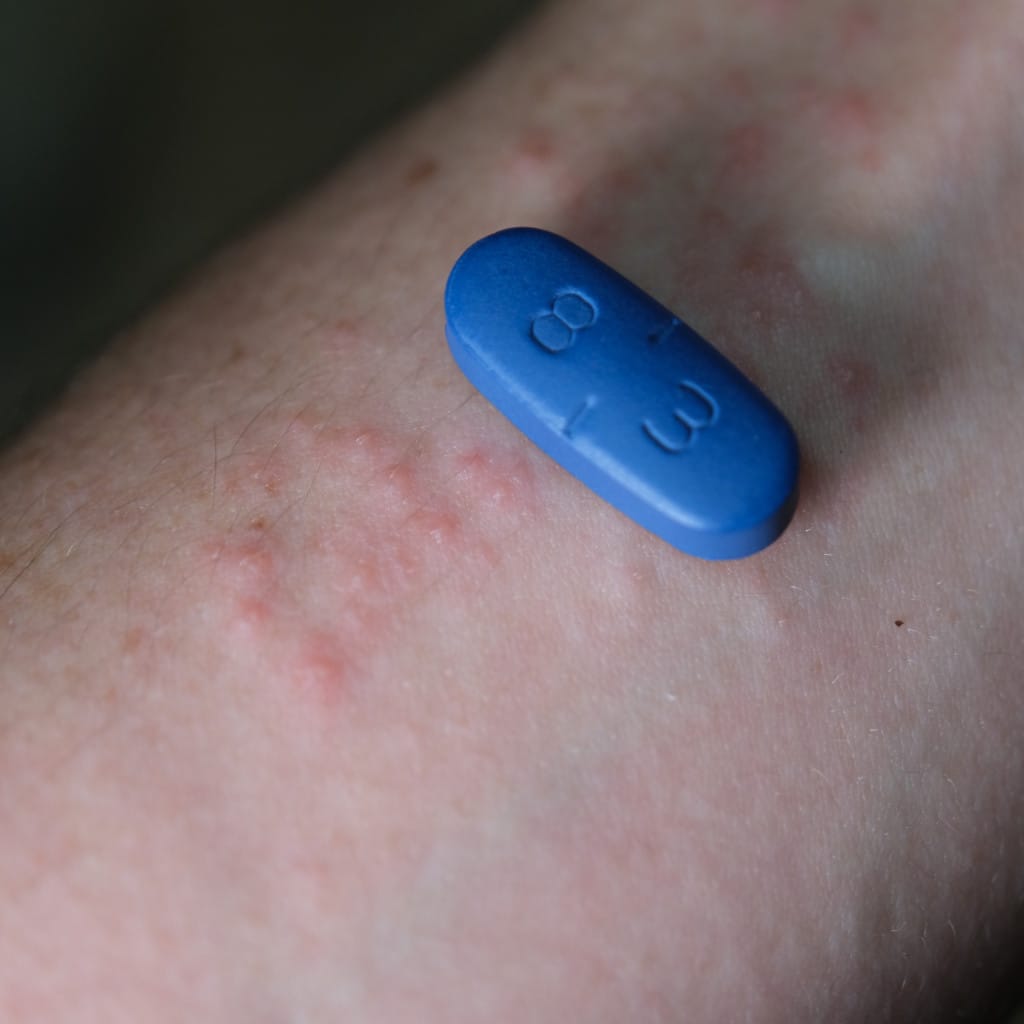 Tratamiento antiviral con valaciclovir para el herpes zóster