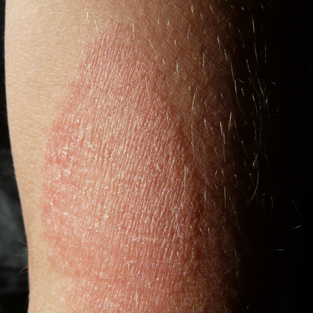 Signos de la dermatitis atópica: placa rosada con descamación fina en el antebrazo