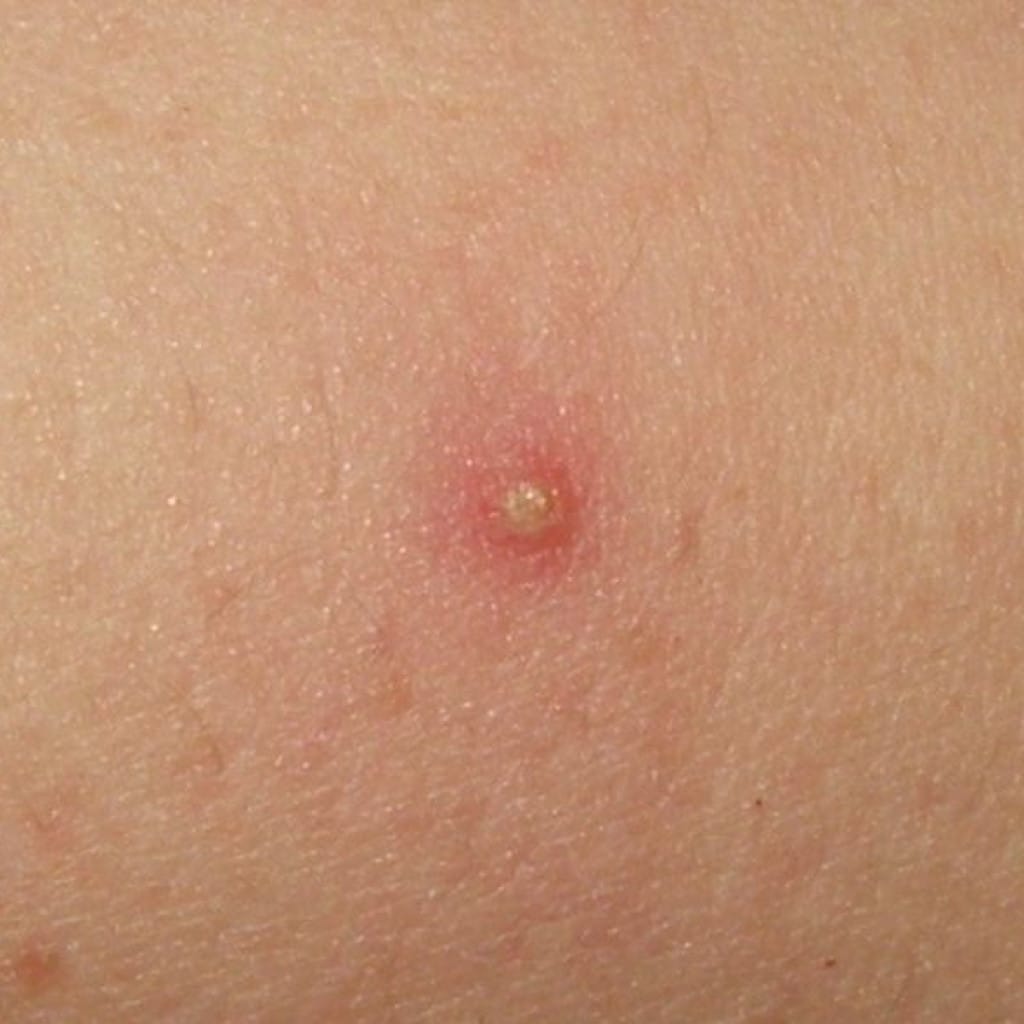 Pústula de foliculitis centrada en un folículo piloso