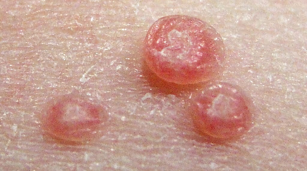 Molusco contagioso en Panamá: pápulas con umbilicación central