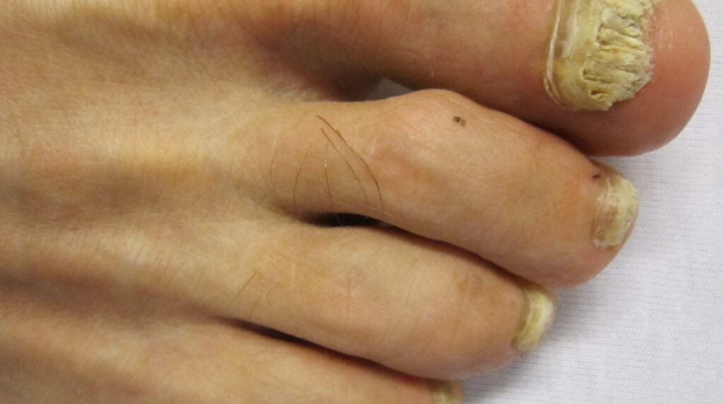 Onicomicosis en el dedo gordo del pie, tratamiento en Panamá