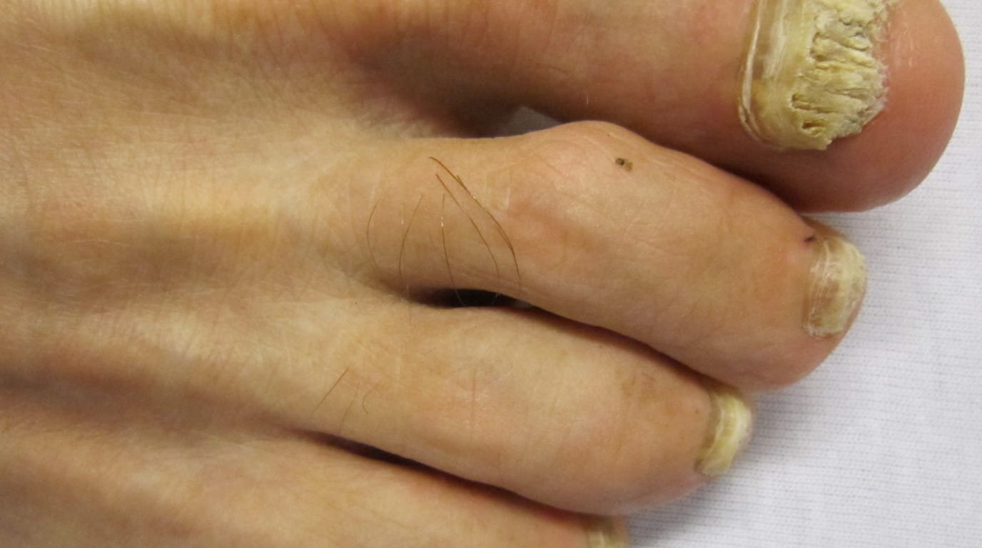 Onicomicosis en el dedo gordo del pie, tratamiento en Panamá