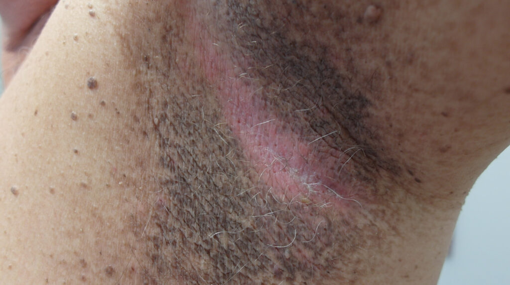 Lesiones en la piel por diabetes en Panamá: piel oscura, engrosada y aterciopelada en la axila de un adulto, acantosis nigricans