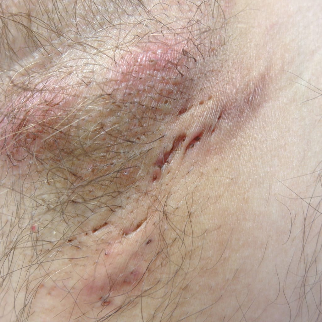 absceso y bandas de cicatriz en la axila, signos de hidradenitis supurativa