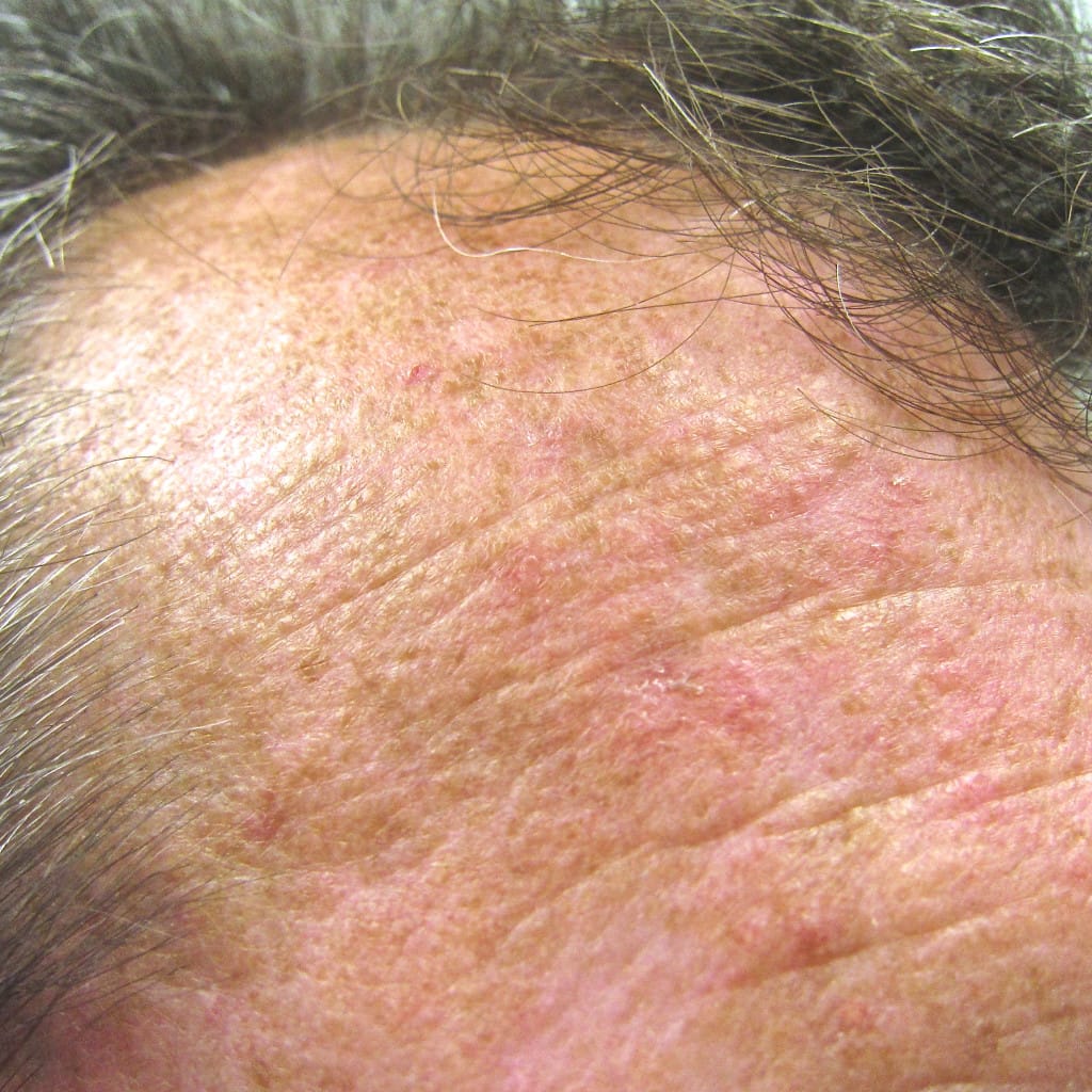 queratosis actínica en la frente, placas ásperas junto a la línea del cabello en un adulto