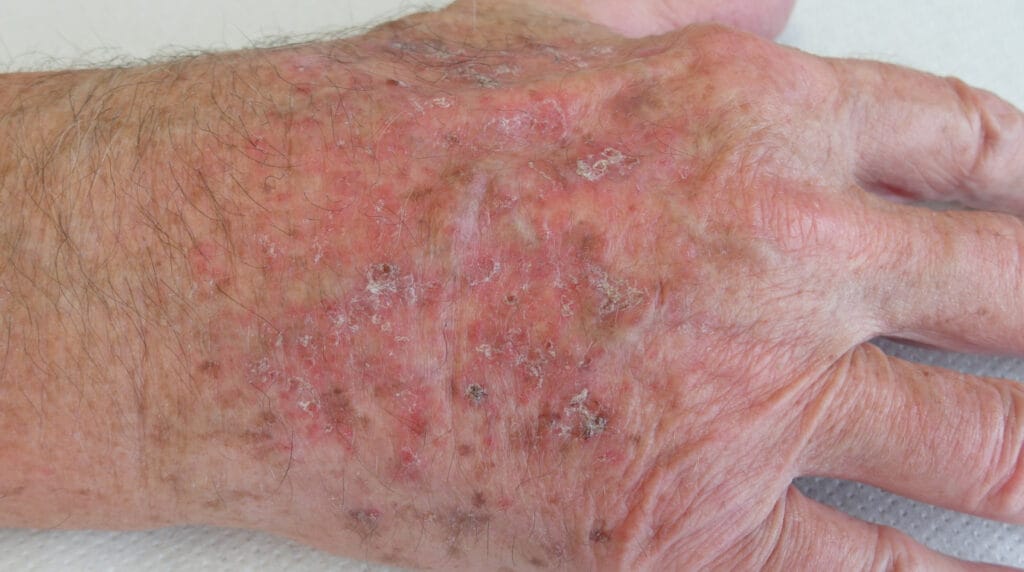 Queratosis actínica en Panamá: placas ásperas y enrojecidas por daño solar en el dorso de la mano de un adulto