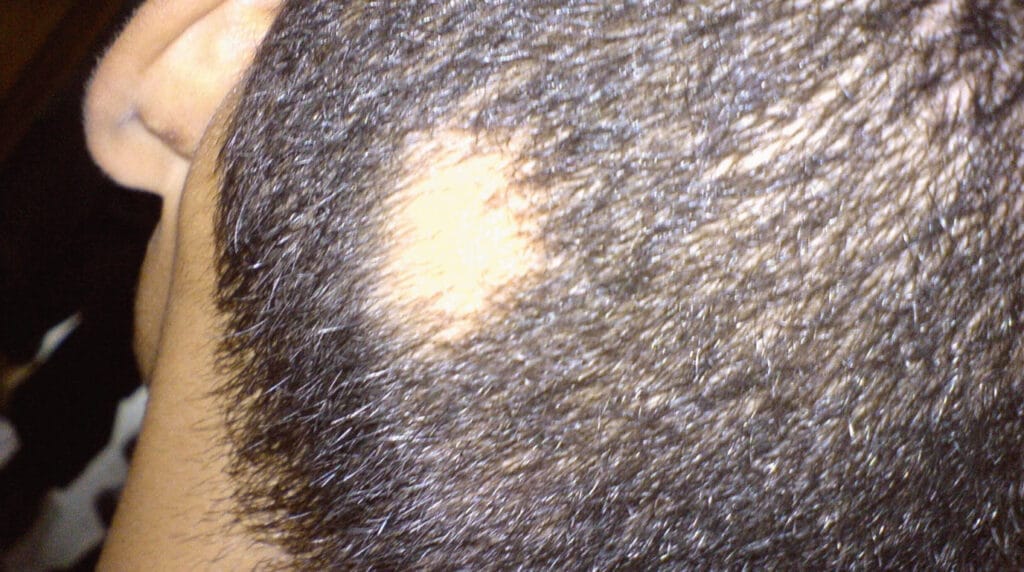 Alopecia areata en Panamá: parche redondo y liso sin pelo en el cuero cabelludo de un adulto