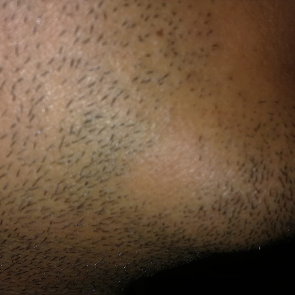 parche liso sin vello en la barba de un adulto, signo de alopecia areata
