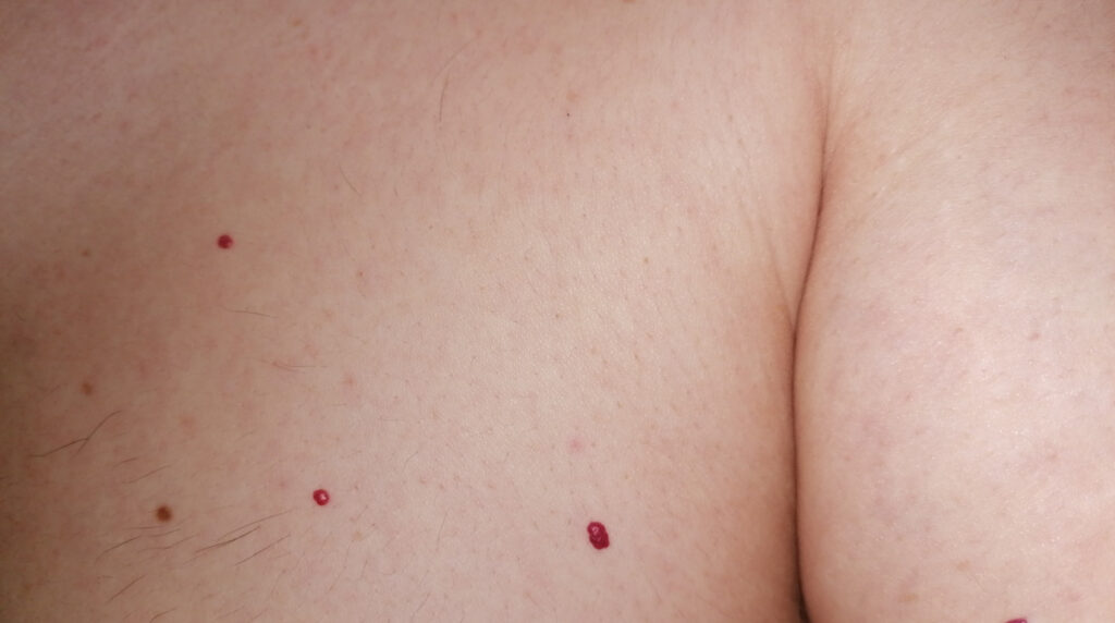Punto rubí en Panamá: puntos rojos brillantes y abultados sobre el pecho y el brazo de un adulto