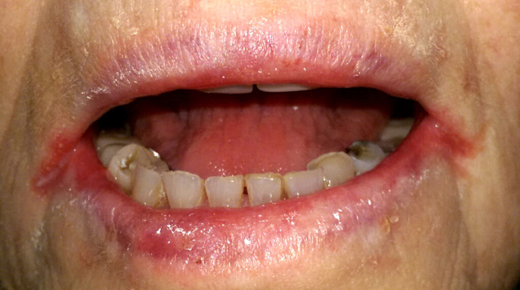 Candidiasis cutánea en Panamá: grietas rojas en las comisuras de la boca de un adulto, boqueras por Candida