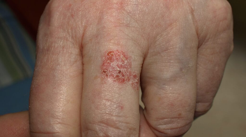 Enfermedad de Bowen en Panamá: placa roja y escamosa de bordes definidos sobre el dorso de la mano de un adulto
