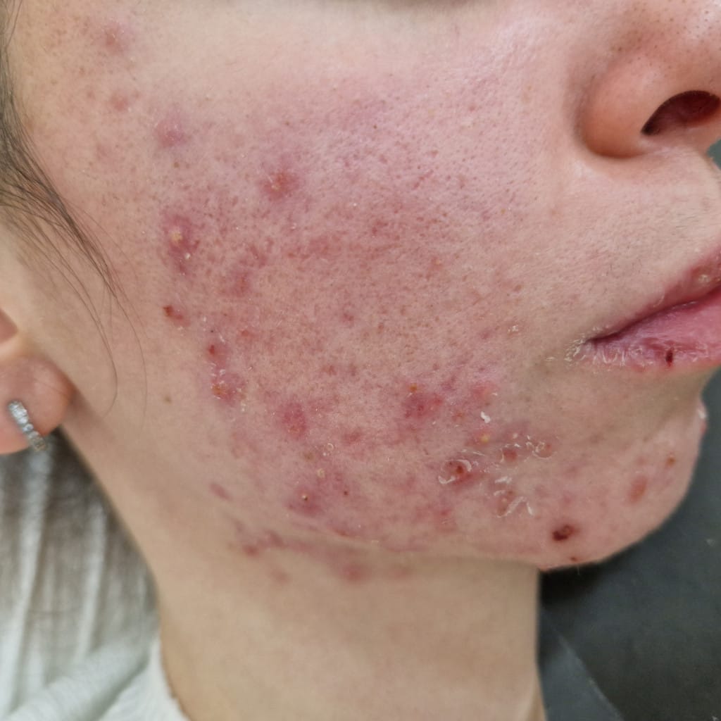 acné inflamatorio en la mejilla de un adulto, causa frecuente de hiperpigmentación postinflamatoria