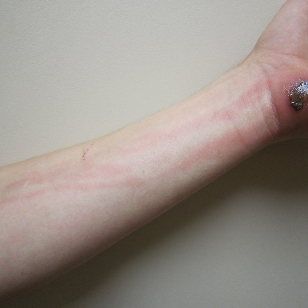 celulitis con enrojecimiento extenso, calor e hinchazón en la extremidad de un adulto