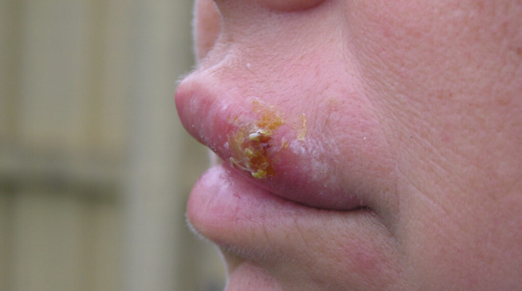 Herpes simple en Panamá: ampolla con costra amarillenta en el borde del labio de un adulto, herpes labial