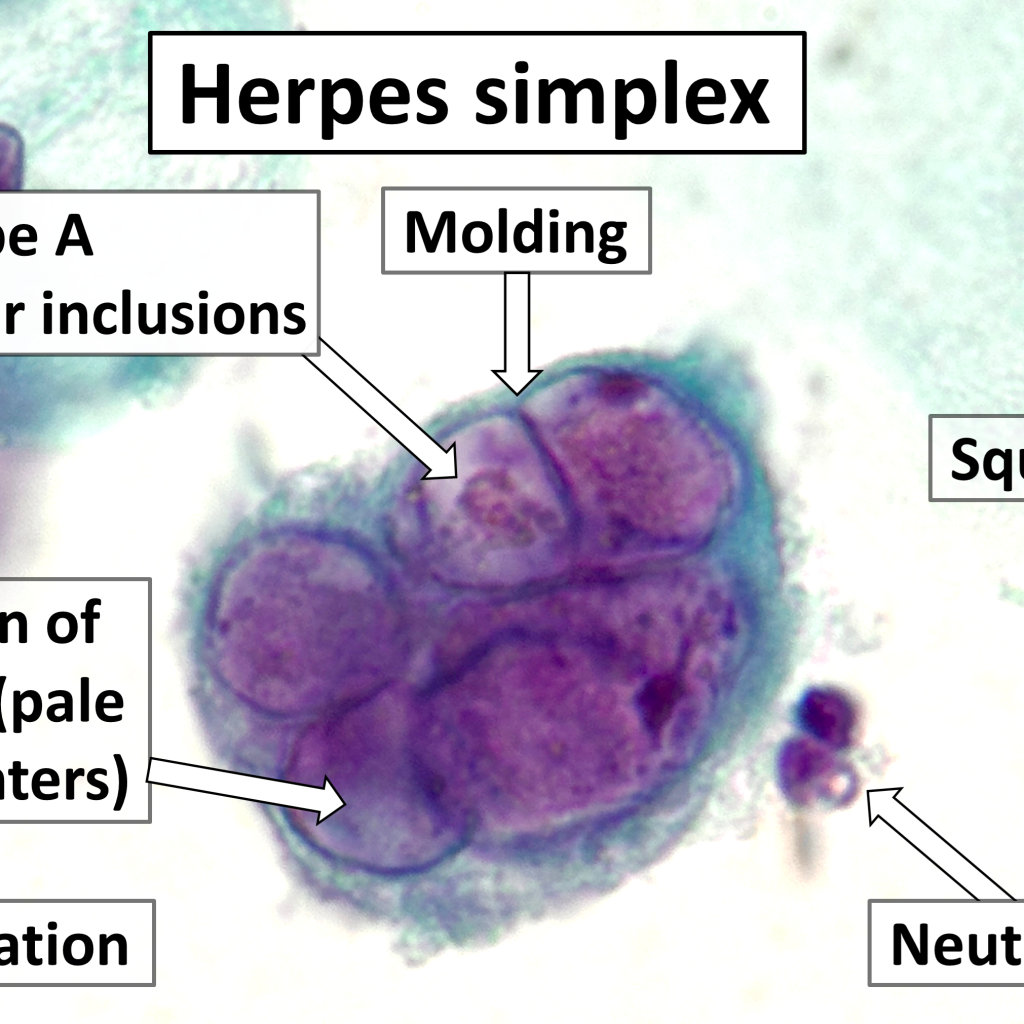 células infectadas por el virus del herpes simple vistas al microscopio, con núcleos agrandados y varios núcleos juntos