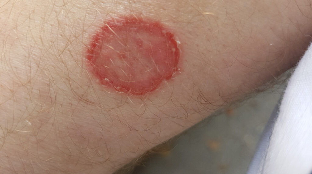 Micosis de la piel en Panamá: placa circular roja con borde elevado en el brazo de un adulto, tiña corporal