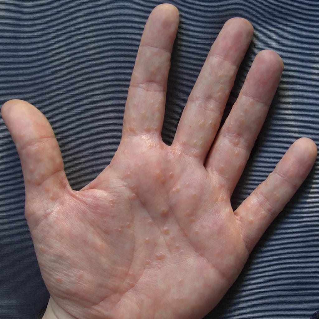 dermatitis de contacto irritativa con vesículas en la palma de la mano