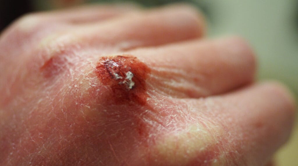 dermatitis por contacto en Panamá — consulta dermatológica con la Dra. Sulem