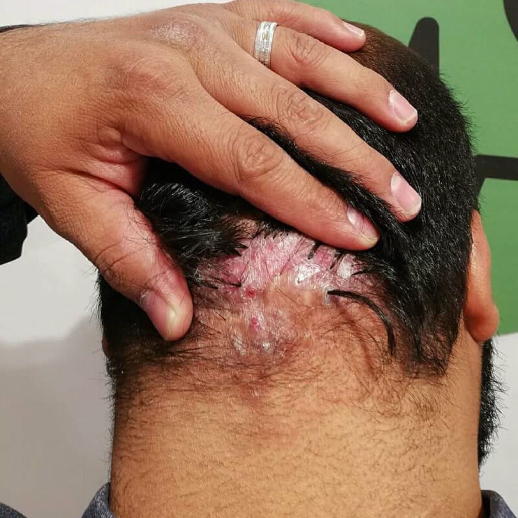 foliculitis decalvante: zona del cuero cabelludo con inflamación, costras y cicatriz en un adulto