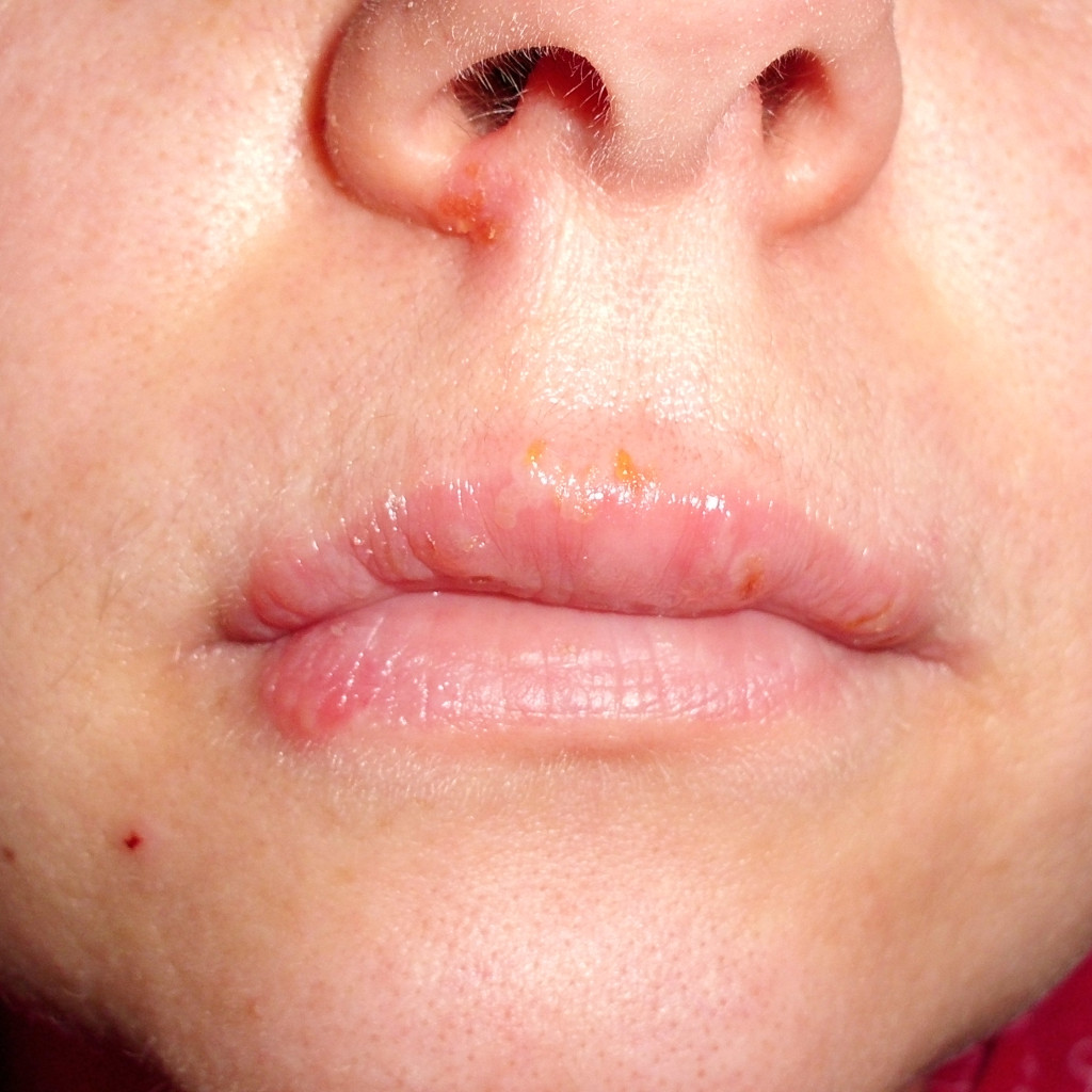 lesión de herpes labial sobre el labio y el contorno de la boca, con enrojecimiento y costra