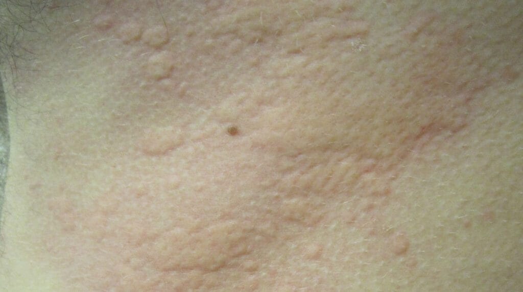 Urticaria crónica en Panamá: ronchas elevadas en la piel de un adulto