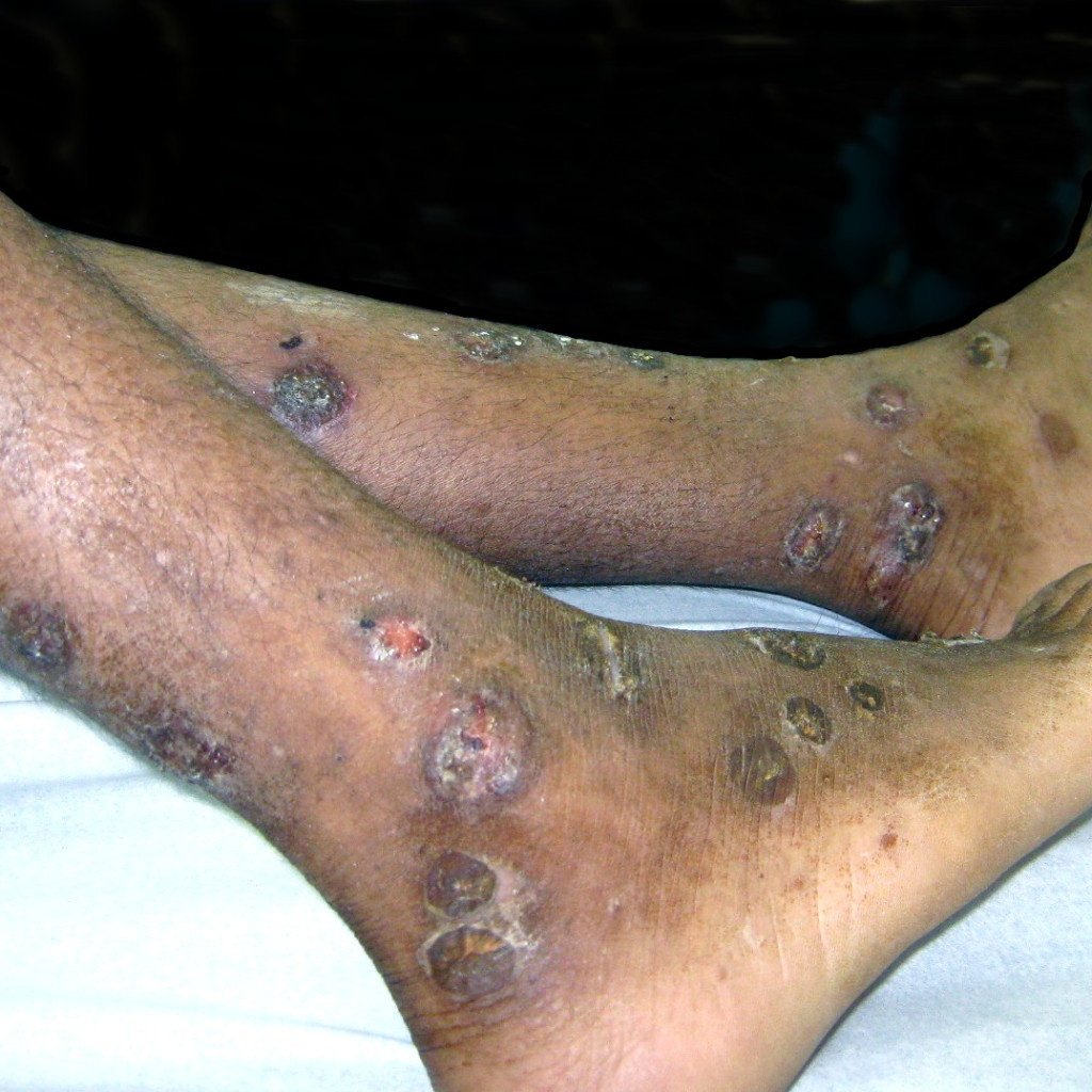 lesiones de impétigo con costras en las piernas y los pies de un adulto