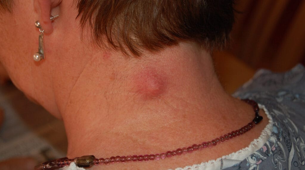 Quiste sebáceo en Panamá: quiste epidermoide inflamado en la nuca de un adulto
