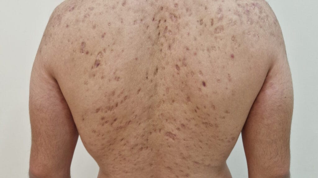 Hiperpigmentación postinflamatoria en Panamá: manchas oscuras tras el acné en la espalda de un adulto