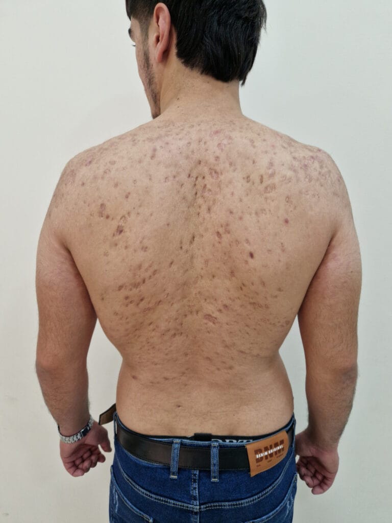 Hiperpigmentación postinflamatoria en Panamá: manchas oscuras tras el acné en la espalda de un adulto