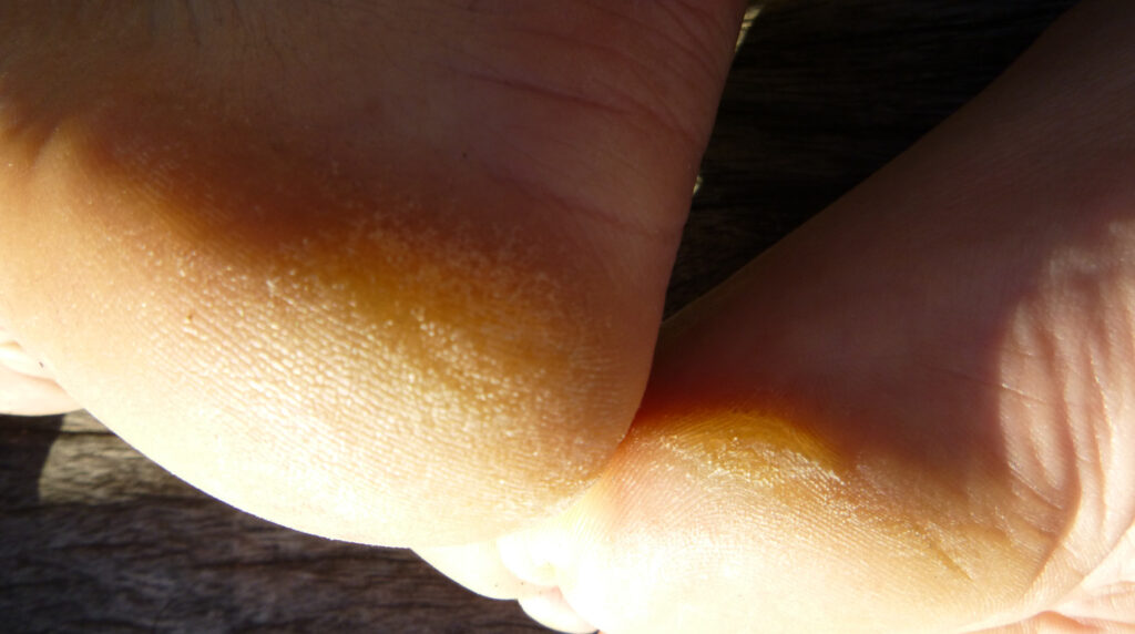 Hiperqueratosis en Panamá: piel gruesa y amarillenta en el talón y el borde del pie de un adulto