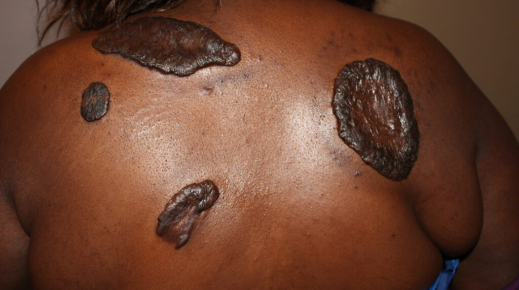 Queloides en Panamá: cicatrices elevadas, firmes y oscuras en la espalda de un adulto de piel morena