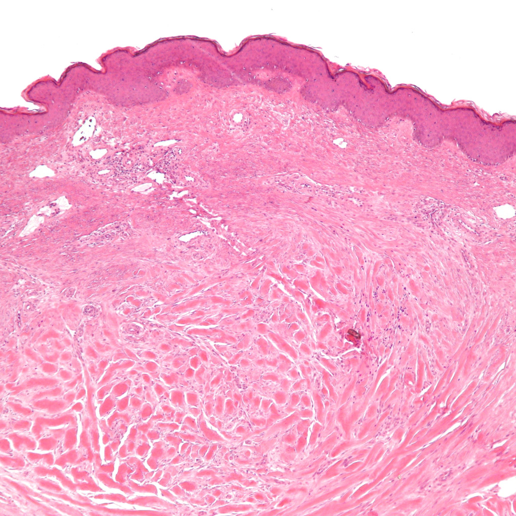 corte de un queloide al microscopio con haces gruesos de colágeno acumulado
