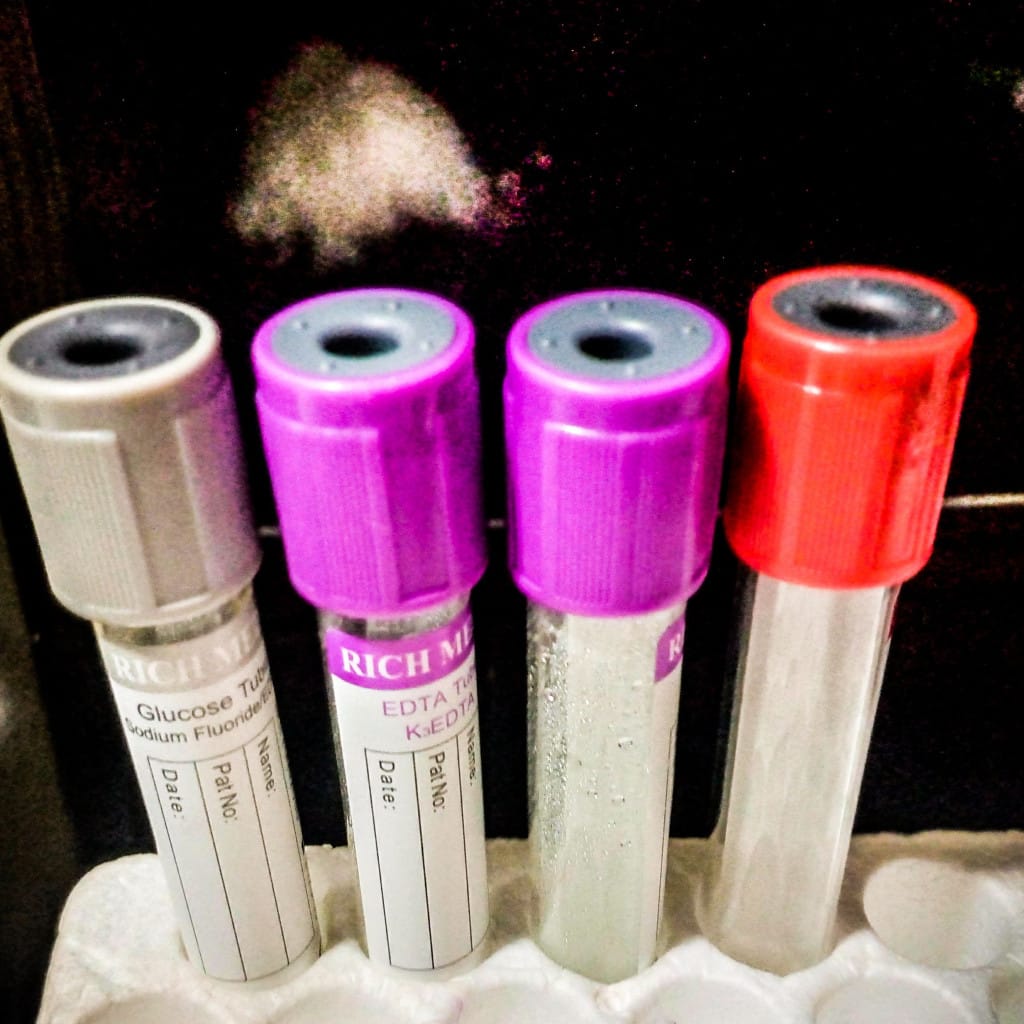 tubos de análisis de sangre para el estudio dirigido de la urticaria crónica