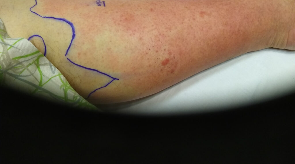 Infecciones bacterianas de la piel en Panamá: celulitis con piel roja, caliente e hinchada en la pierna de un adulto