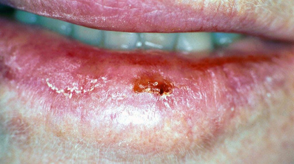 Carcinoma espinocelular en Panamá: lesión ulcerada y costrosa en el labio inferior de un adulto
