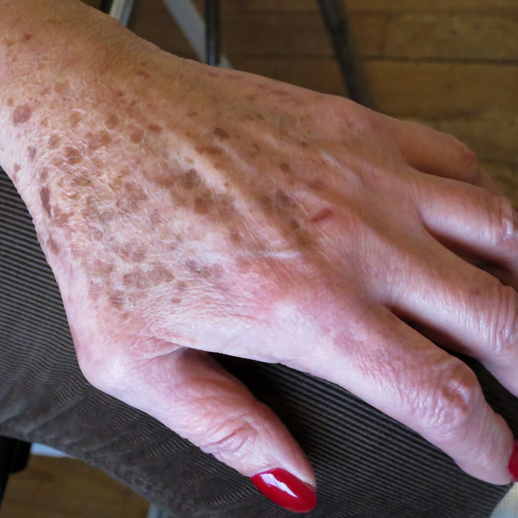 lentigos solares marrones de bordes definidos en el dorso de la mano de una persona adulta