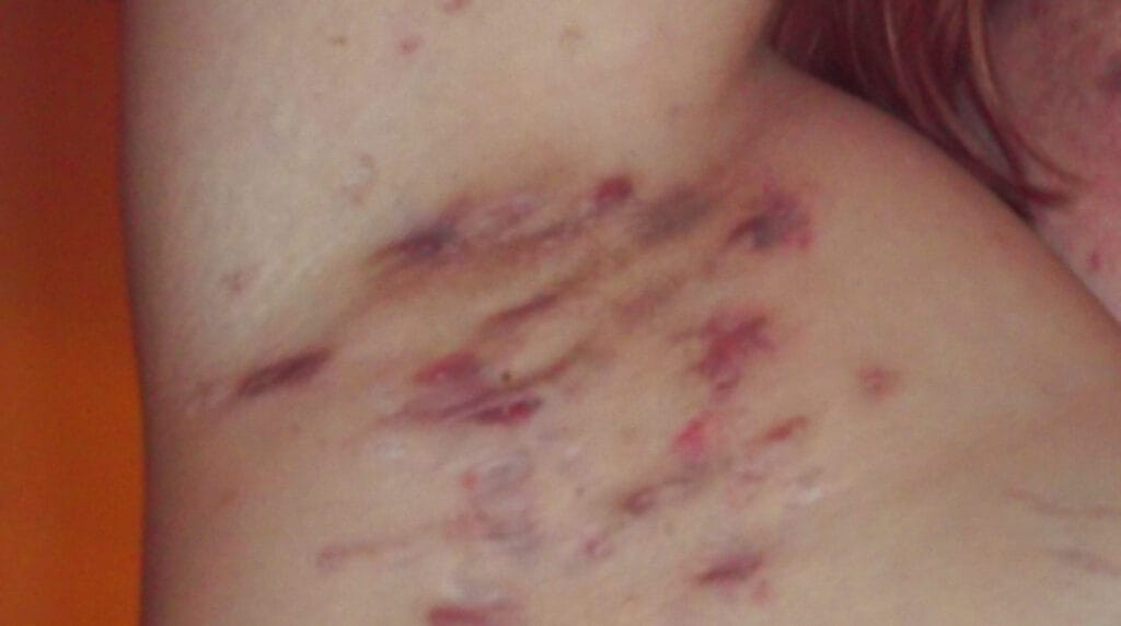Hidradenitis supurativa en Panamá: nódulos inflamados en la axila de un adulto