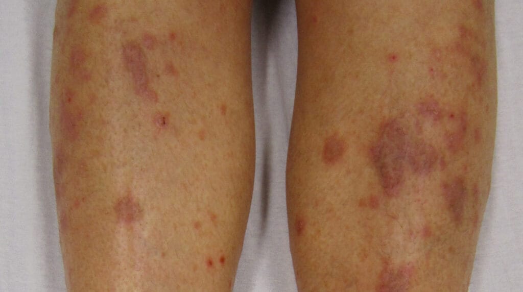 Liquen plano en Panamá: pápulas violáceas y planas en la piel de un adulto