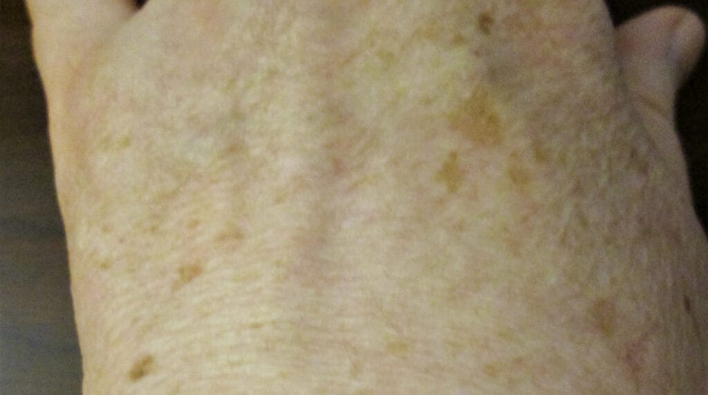 Manchas solares en Panamá: lentigos solares en el dorso de la mano de un adulto