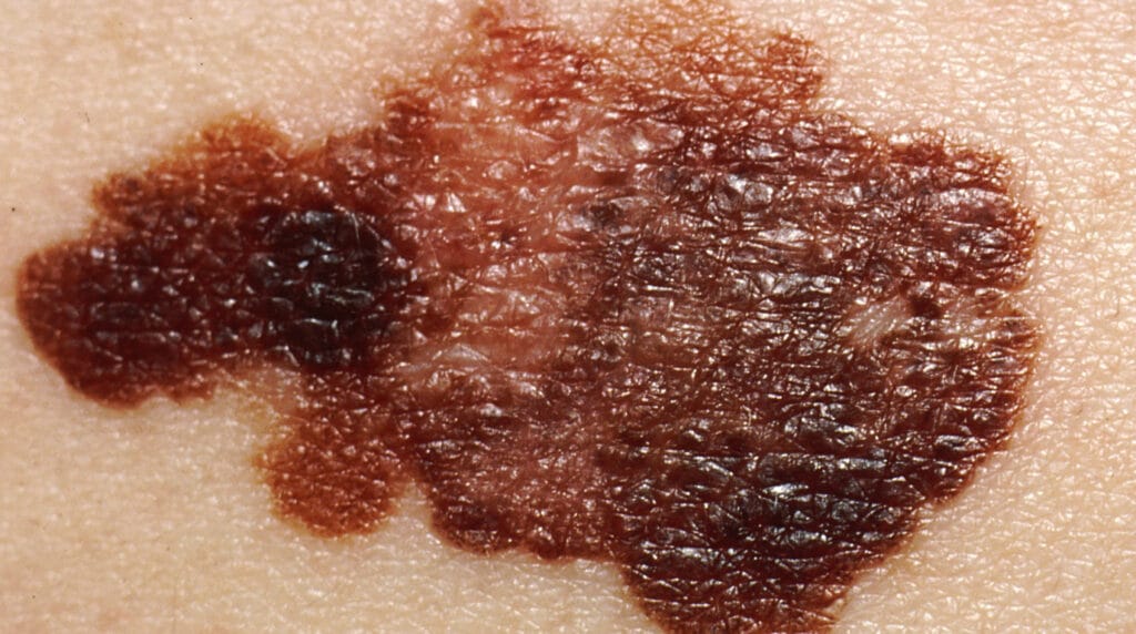 Melanoma en Panamá: lesión pigmentada asimétrica con bordes irregulares y varios tonos en la piel