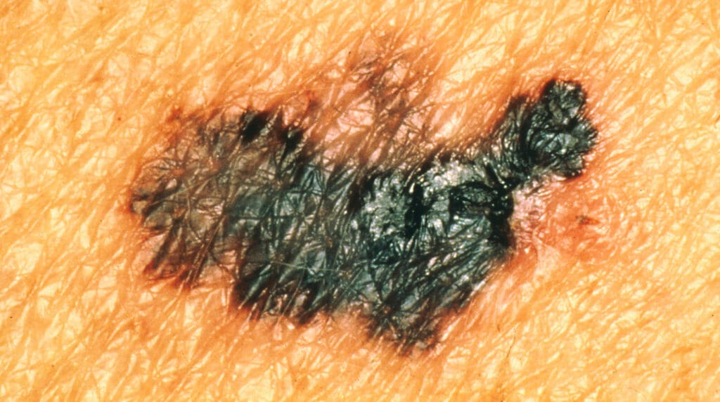 Cáncer de piel en Panamá: melanoma de bordes irregulares y varios colores en la piel de un adulto