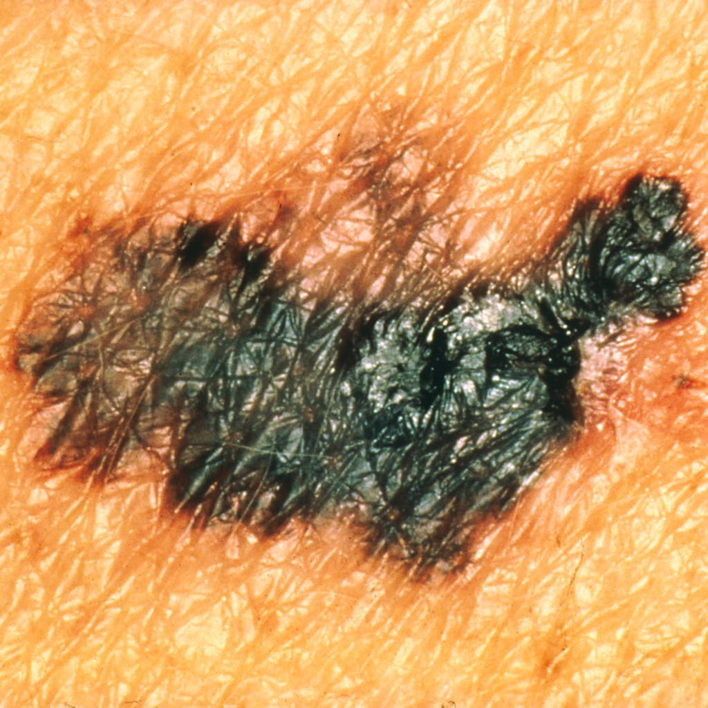 melanoma con variación de colores y bordes irregulares, señales de alerta de la regla ABCDE