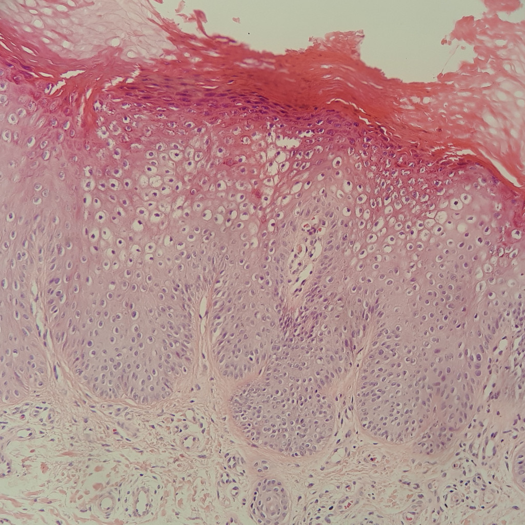 corte al microscopio de una verruga plana que muestra los cambios que produce el virus del papiloma humano