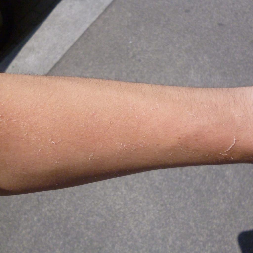 brazo con quemadura solar leve, una de las exposiciones que aumentan el riesgo de cáncer de piel