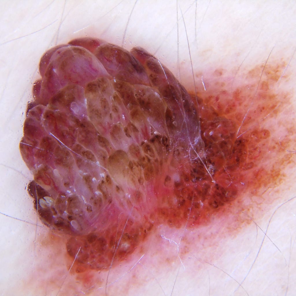 imagen dermatoscópica de una lesión pigmentada, estudio que permite distinguir un lunar benigno de uno sospechoso